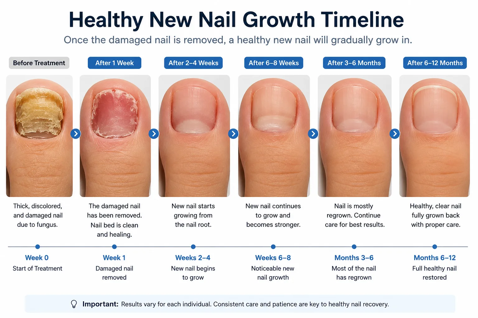 Healthy new nail growth timeline: from damaged nail to fully regrown clear nail over 6–12 months