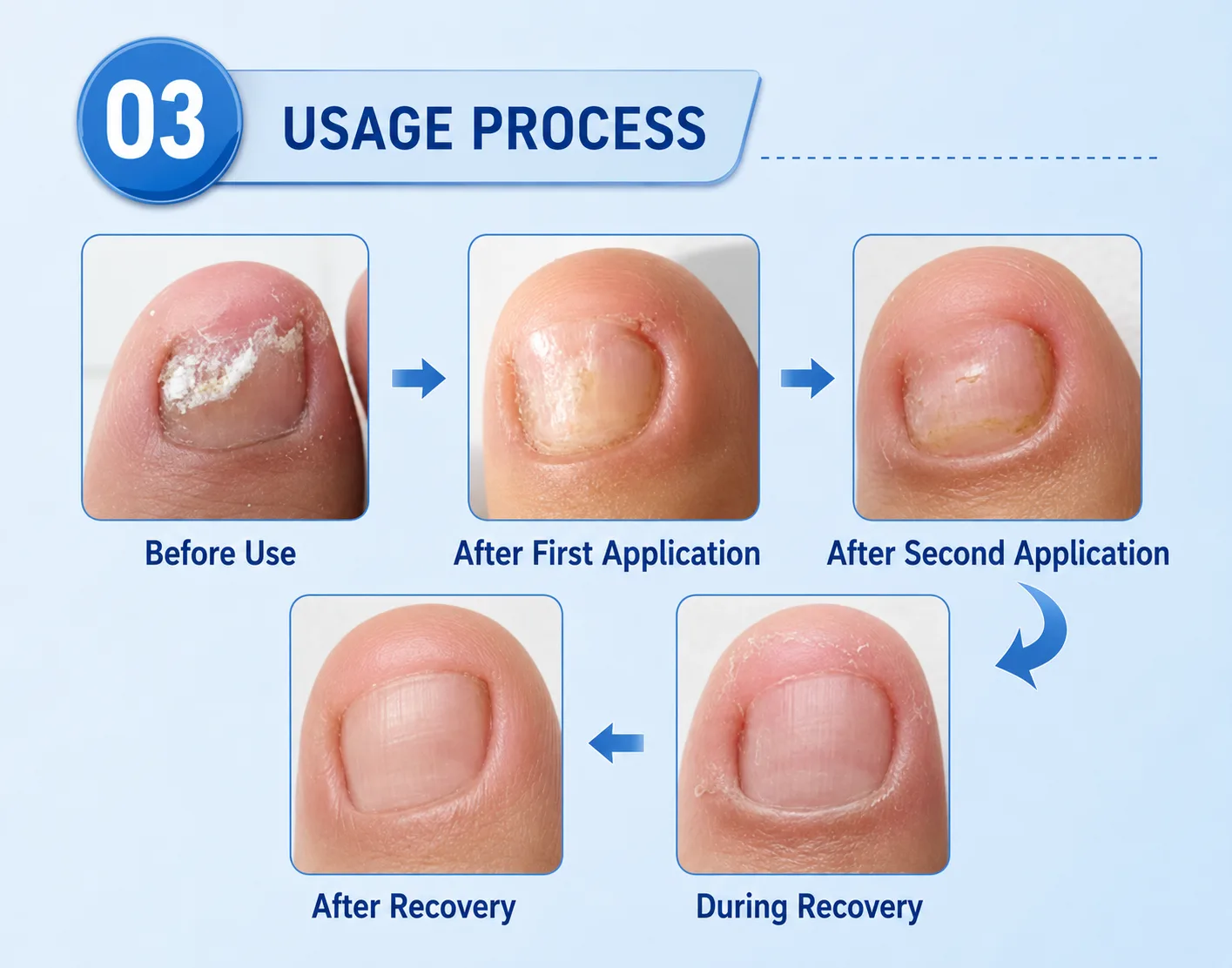 Usage process: applying and wrapping the herbal nail cream